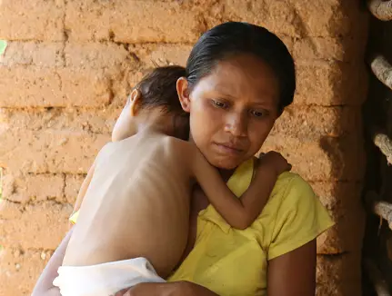 2015, Honduras, Child suffering from Malnutrition