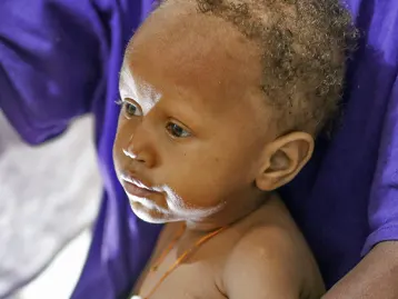 Malnutrition in Haiti