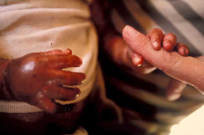 Dr. Lynne Nasrallah holds the finger of a baby boy with a severe skin disease in Haiti.
